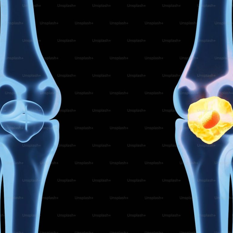 Knee rehabilitation